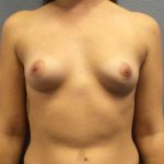Breast Augmentation Before & After Patient #11487