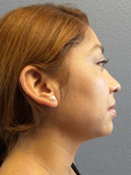 Liposuction of the Neck Before & After Patient #12082