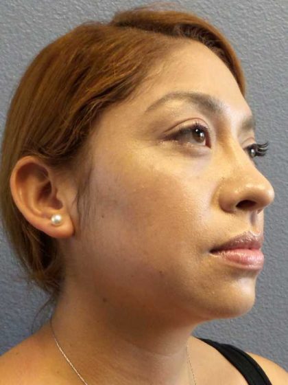 Liposuction of the Neck Before & After Patient #12082