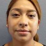 Liposuction of the Neck Before & After Patient #12082