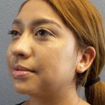 Liposuction of the Neck Before & After Patient #12082