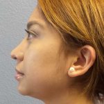 Liposuction of the Neck Before & After Patient #12082
