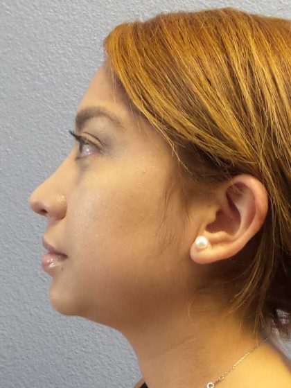 Liposuction of the Neck Before & After Patient #12082