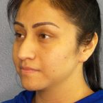 Rhinoplasty Before & After Patient #12384