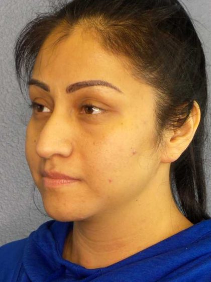 Rhinoplasty Before & After Patient #12384