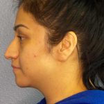 Rhinoplasty Before & After Patient #12384