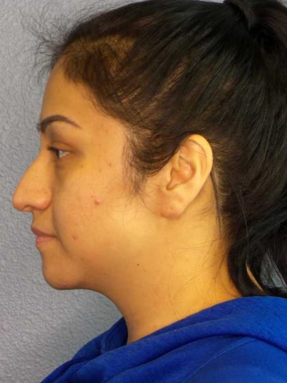 Rhinoplasty Before & After Patient #12384