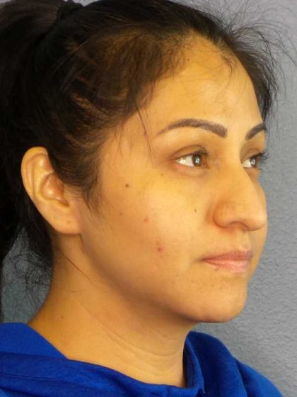 Rhinoplasty Before & After Patient #12384