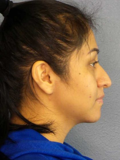 Rhinoplasty Before & After Patient #12384