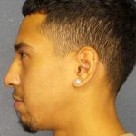 Rhinoplasty Before & After Patient #12373