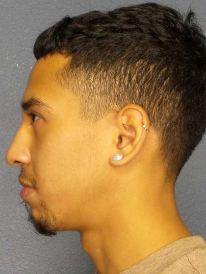 Rhinoplasty Before & After Patient #12373