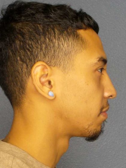 Rhinoplasty Before & After Patient #12373
