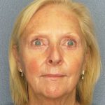 Facelift Before & After Patient #7577