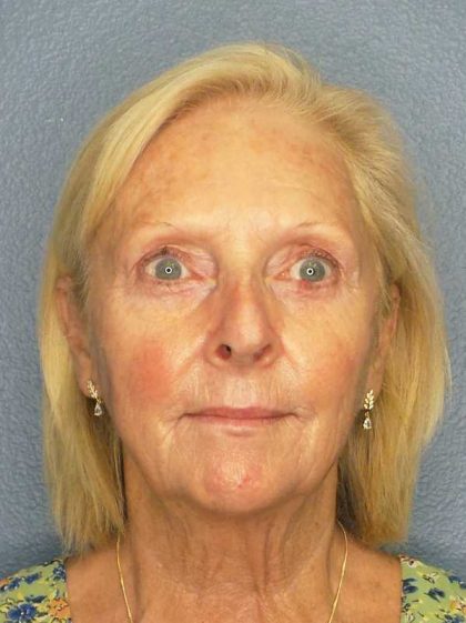 Facelift Before & After Patient #7577