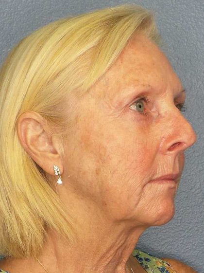 Facelift Before & After Patient #7577