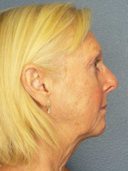 Facelift Before & After Patient #7577