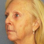 Facelift Before & After Patient #7577