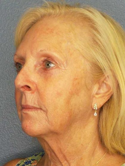 Facelift Before & After Patient #7577