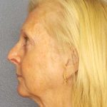 Facelift Before & After Patient #7577