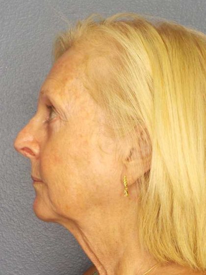 Facelift Before & After Patient #7577