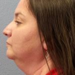Liposuction of the Neck Before & After Patient #12148