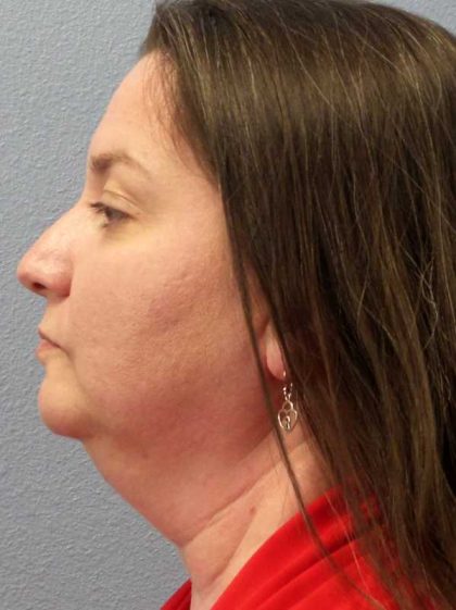 Liposuction of the Neck Before & After Patient #12148