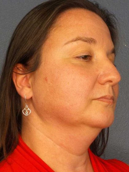 Liposuction of the Neck Before & After Patient #12148