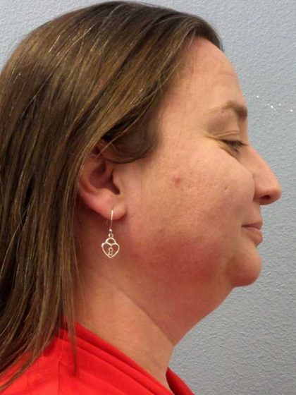 Liposuction of the Neck Before & After Patient #12148