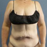 High BMI (Larger Patients) Surgery Before & After Patient #10381