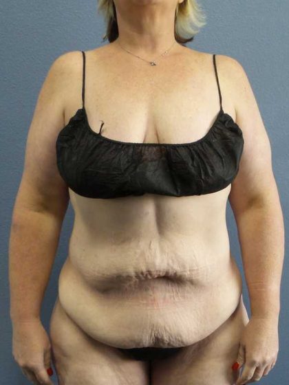High BMI (Larger Patients) Surgery Before & After Patient #10381