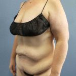 High BMI (Larger Patients) Surgery Before & After Patient #10381