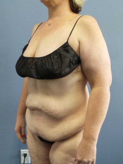 High BMI (Larger Patients) Surgery Before & After Patient #10381
