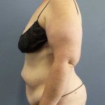 High BMI (Larger Patients) Surgery Before & After Patient #10381