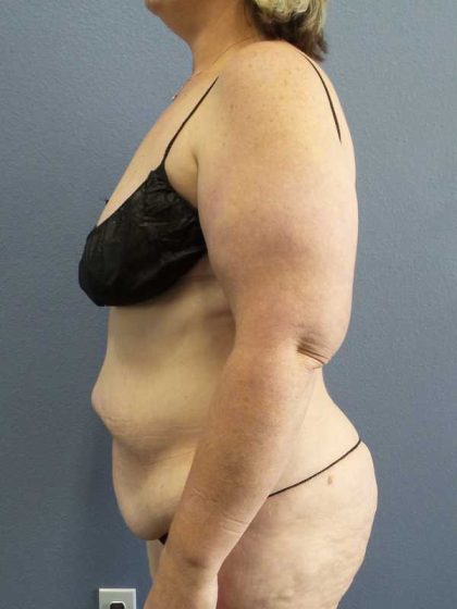 High BMI (Larger Patients) Surgery Before & After Patient #10381
