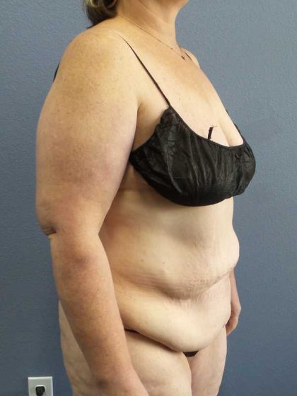 High BMI (Larger Patients) Surgery Before & After Patient #10381
