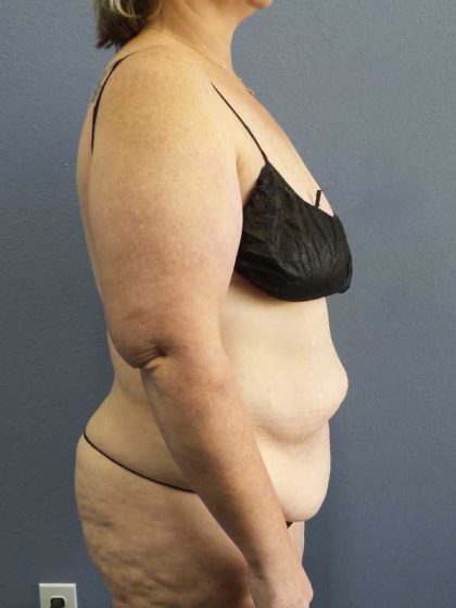High BMI (Larger Patients) Surgery Before & After Patient #10381