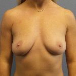 Breast Augmentation Before & After Patient #11414