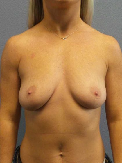 Breast Augmentation Before & After Patient #11414