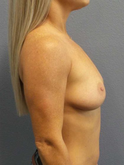 Breast Augmentation Before & After Patient #11414