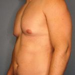 Male Liposuction Before & After Patient #8201