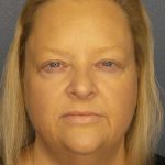 Facelift Before & After Patient #11629