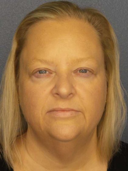 Facelift Before & After Patient #11629