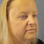 Facelift Before & After Patient #11629