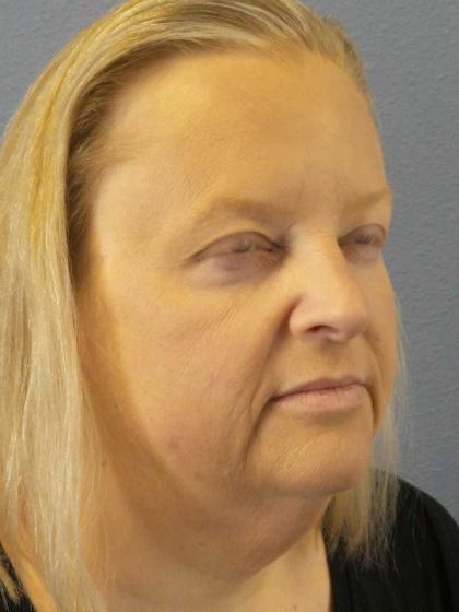 Facelift Before & After Patient #11629