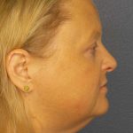 Facelift Before & After Patient #11629
