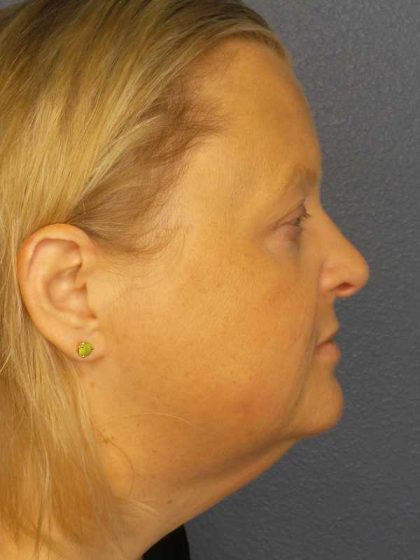 Facelift Before & After Patient #11629