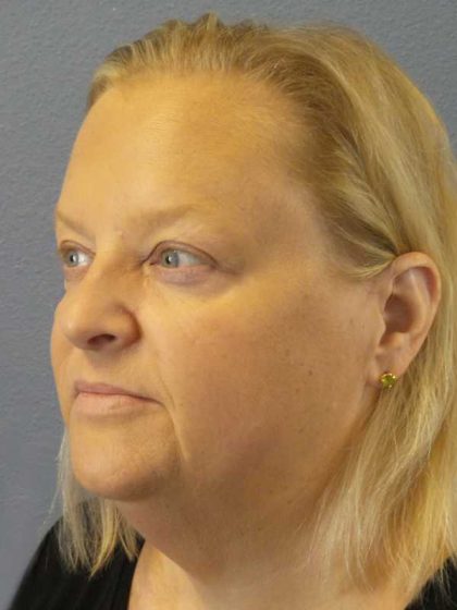 Facelift Before & After Patient #11629