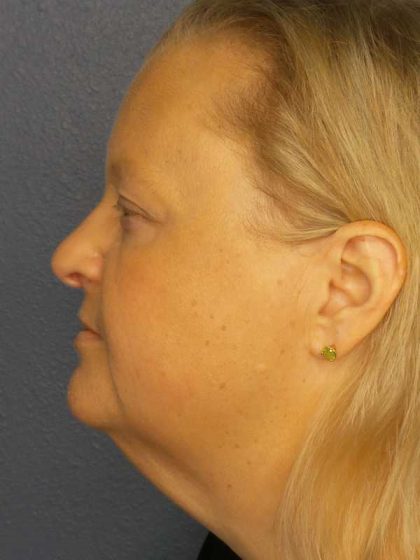 Facelift Before & After Patient #11629