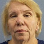 Facelift Before & After Patient #7573