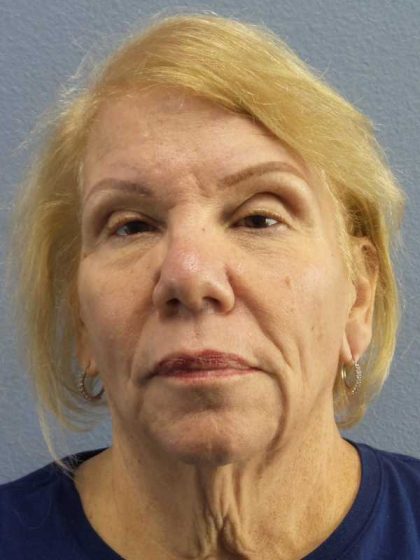 Facelift Before & After Patient #7573